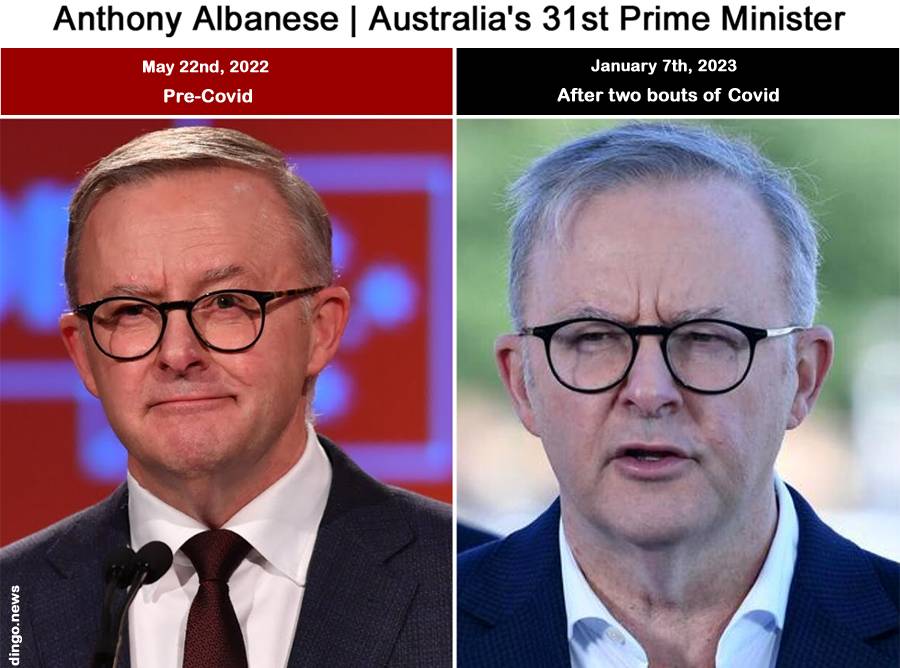 Australian PM Anthony Albanese: The Before and After Poster-Boy for why you don’t want Covid – Mick Lawless